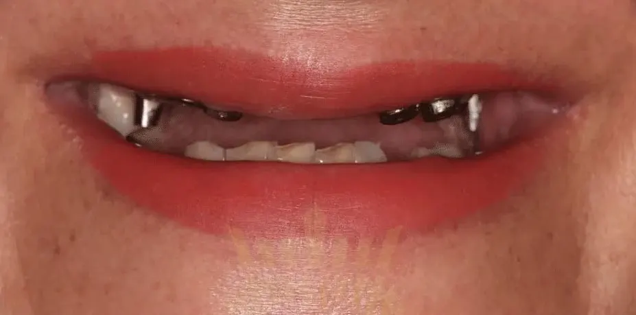 Dental Implants unique dental