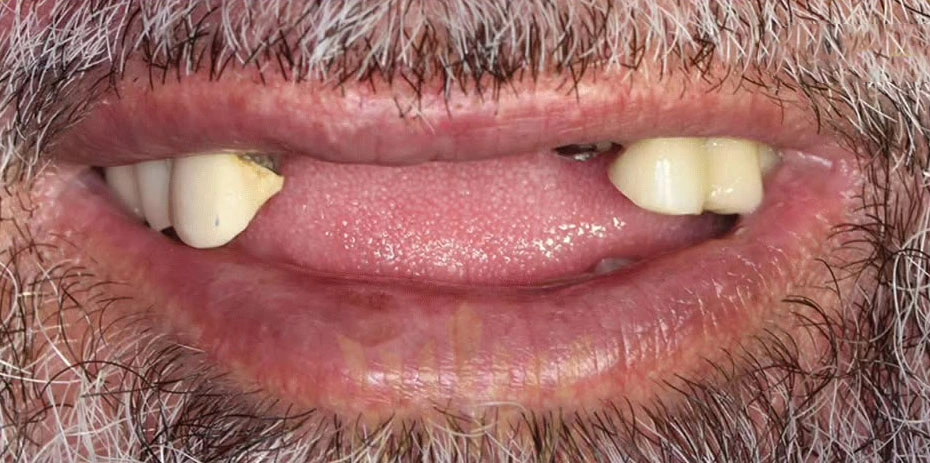 dental implant crowns unique dental