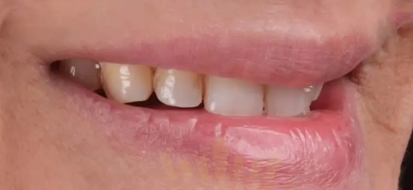 Endodontic Treatments