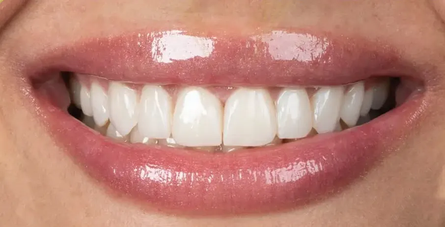 dr. najme khadematolrasoul Smile Design